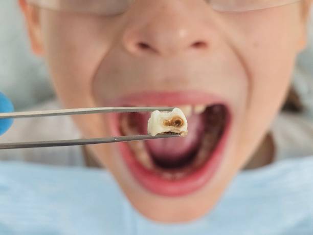 Best Emergency Gum Treatment in Hamilton, MO